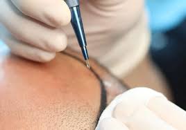 Best Hair Transplant Doctor in Delhi NCR Get your look now