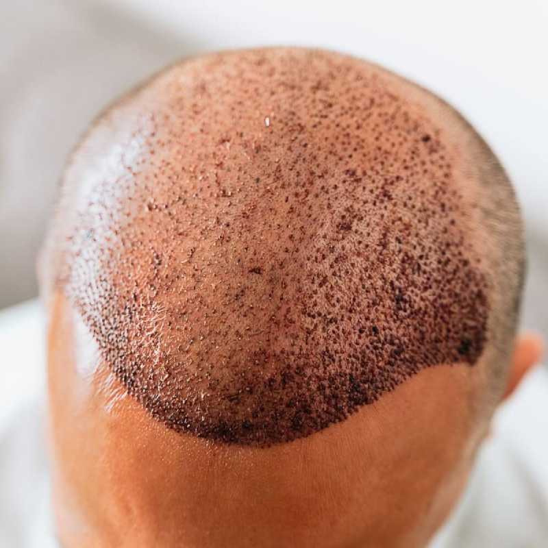 Best Hair Transplant in Delhi Complete Guide to cost clinics and best doctors