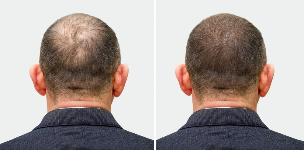 Beyond the Scalp Why Body Hair Transplants Are Becoming the Future of Hair Restoration