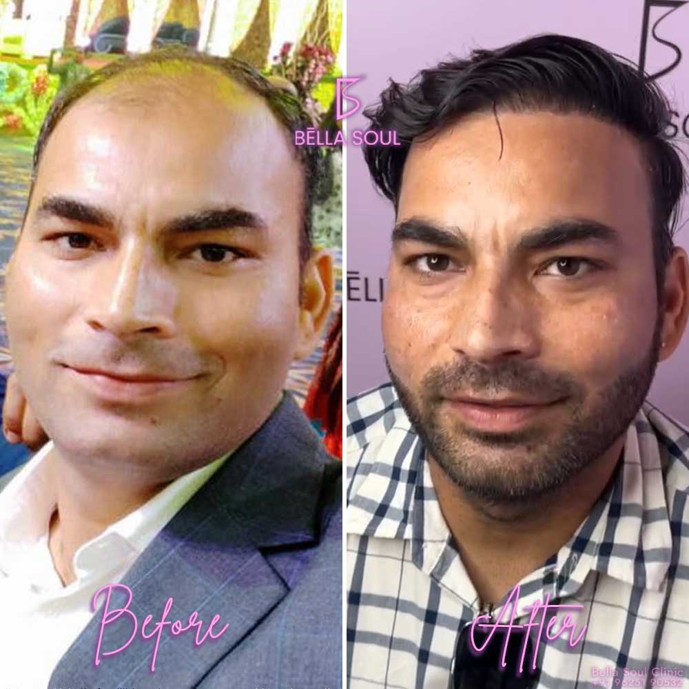 Confident Hair Restoration How to find the Best Hair Transplant Clinic in Delhi 