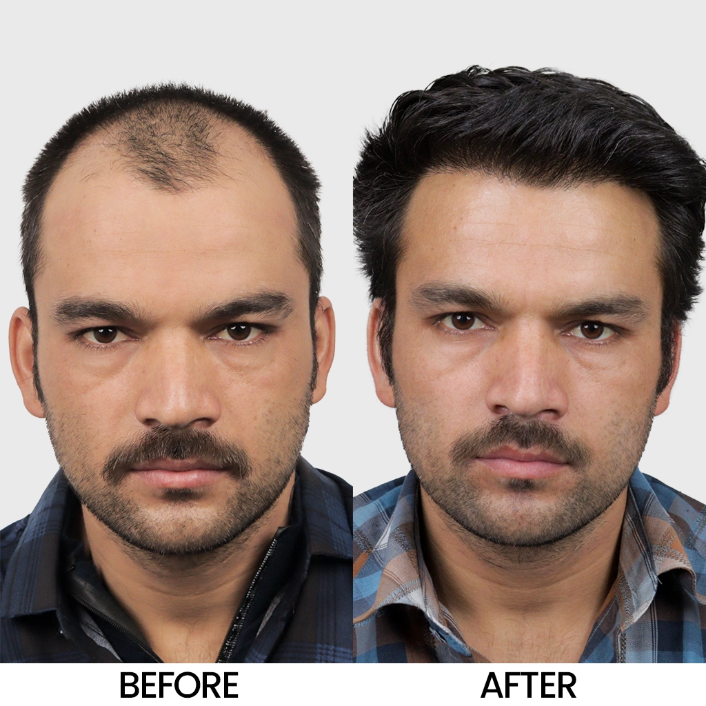 FUE vs FUT Hair Transplant Cost in Delhi Which One Gives Better Value