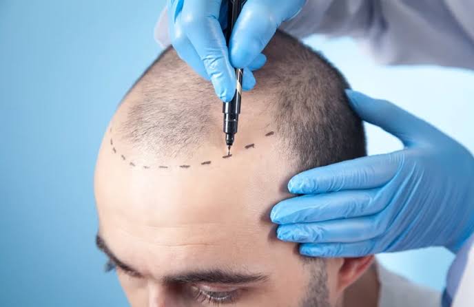 Hair Transplant Cost in Delhi Complete Price Guide for 2026