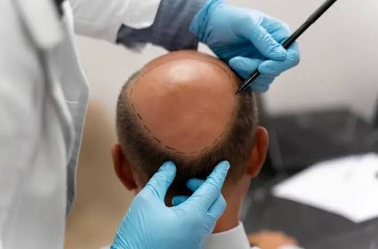Hair Transplant Cost in Delhi Complete Price Guide for 2026
