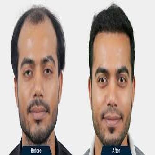 The best hair transplant clinic in delhi ncr a comprehensive guide to cost clinics and doctors