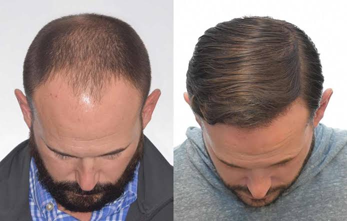 What Factors Affect Hair Transplant Cost in Delhi