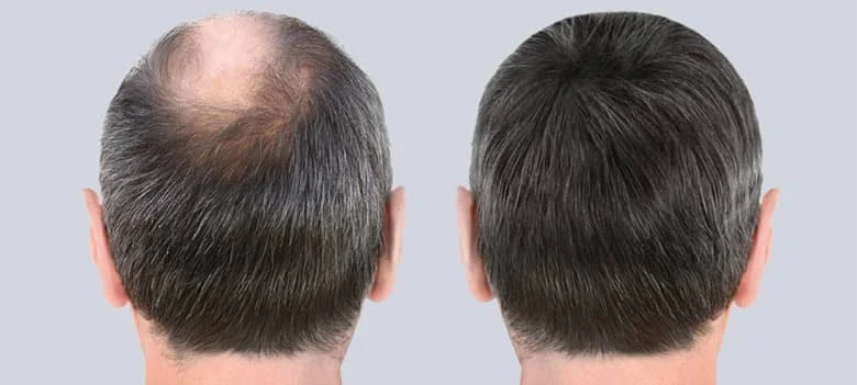What Is a FUE Hair Transplant Benefits, Procedure, and Recovery