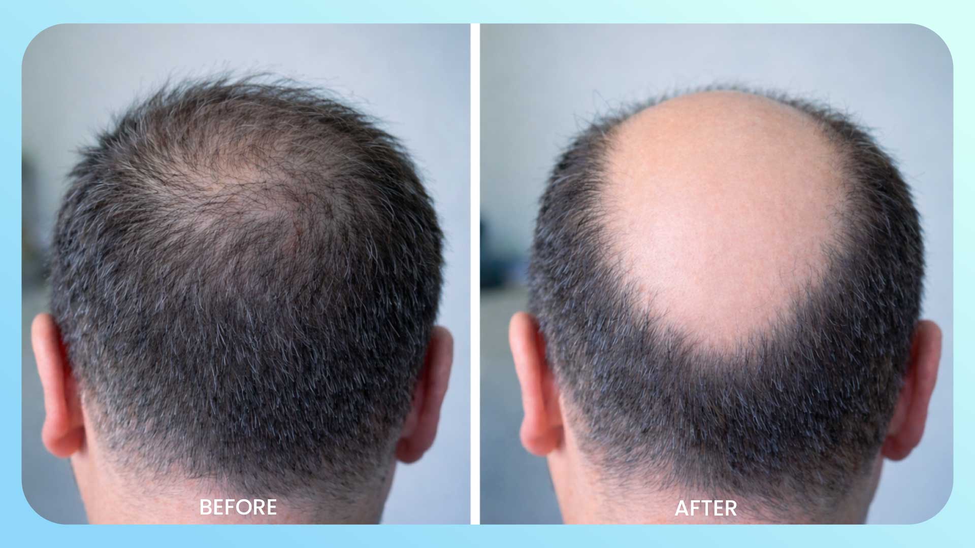Why is the Selection of the Right Clinic Important for Hair Transplant More Than Cost?