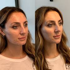 Chin Filler Treatment in Delhi