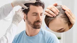 Choosing the Right Hair Transplant Clinic in Delhi for a Natural and Long Lasting Hair Restoration