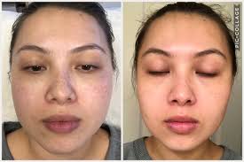 Face Slimming Treatment in Delhi 