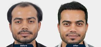 Get Your Confidence Back with the Best Hair Transplant Clinic in Delhi