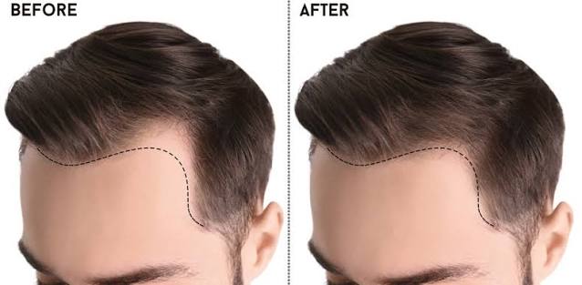 Hair Transplant Cost in South Delhi: Pricing Guide for 2026