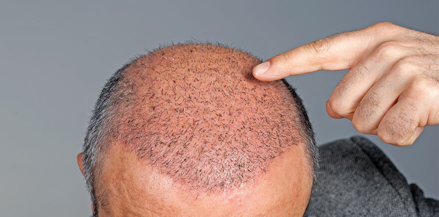 Understanding Hair Transplant Cost in Delhi and Choosing the Right Clinic for Natural Hair Restoration