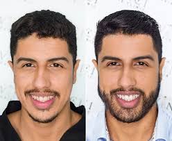 Beard Hair Transplant in Siddharthnagar