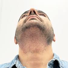 Body Hair Transplant in Koderma