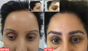 Eyebrow Hair Transplant in Delhi