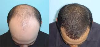 FUE Hair Transplant in Manesar