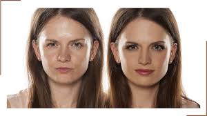 Face Bone Alteration in Haridwar