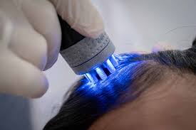 Laser Hair Loss Treatment in Delhi