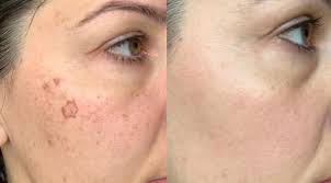 Pigmentation Removal Treatments in Barabanki