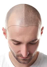 Scalp Micropigmentation in Mathura