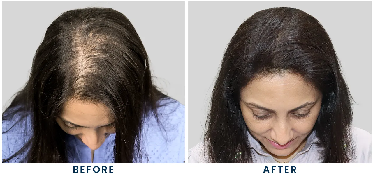 Women and Female Hair Transplant in Delhi