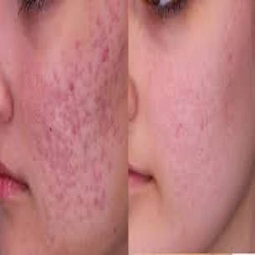 Acne Scar Treatment in Chhatarpur