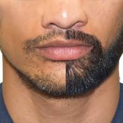 Beard Hair Transplant in Mathura