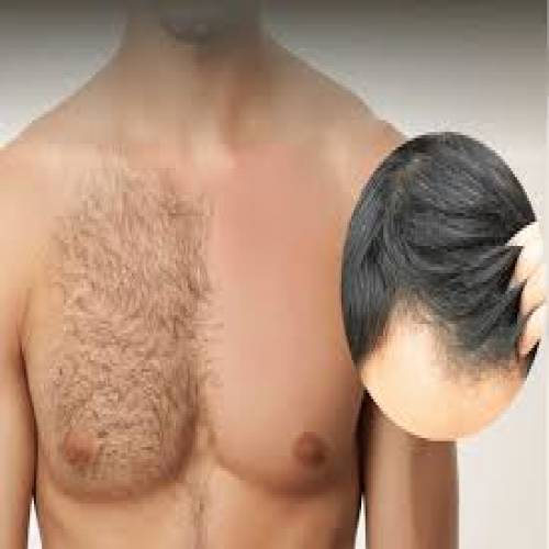 Body Hair Transplant in Mathura