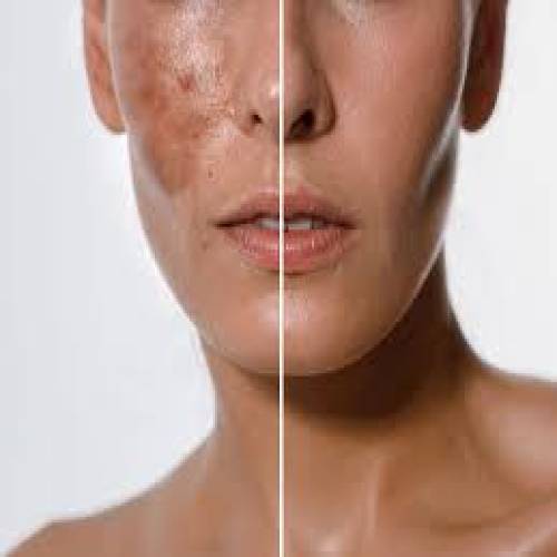Chemical Peel Treatment in Chhatarpur