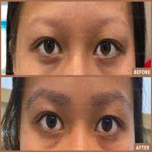 Eyebrow Hair Transplant in Mathura
