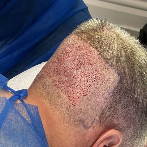 FUE Hair Transplant in Mathura