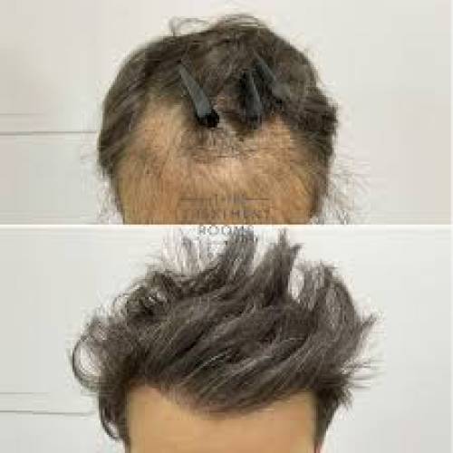 Hair Transplant Repair in Mathura