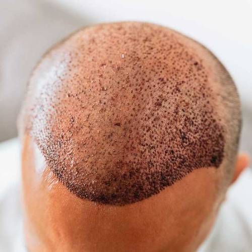 Hair Transplant in Panipat