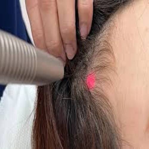 Laser Hair Loss Treatment in Sikar