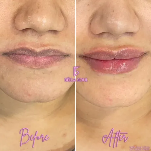 Lip Filler in Godda