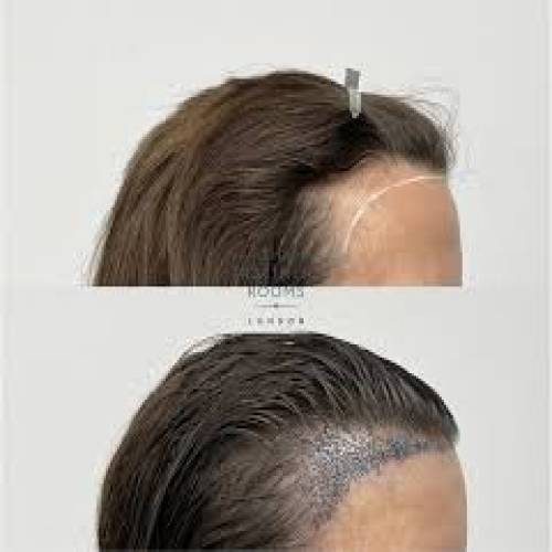 Women and Female Hair Transplant in Mathura