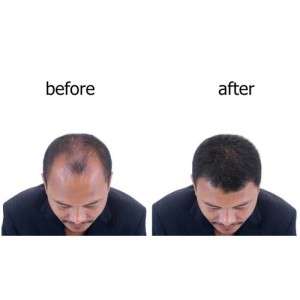 DHI Hair Transplant in Delhi