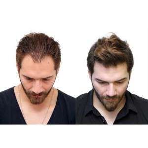 FUE Hair Transplant in Delhi