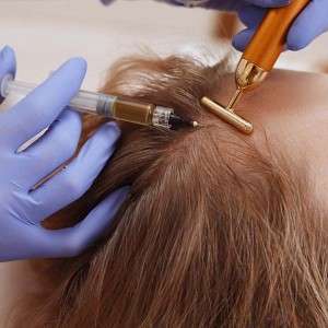 Hair Areata Treatment in Delhi