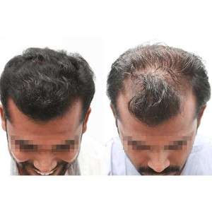 Hair Fall Treatment in Delhi