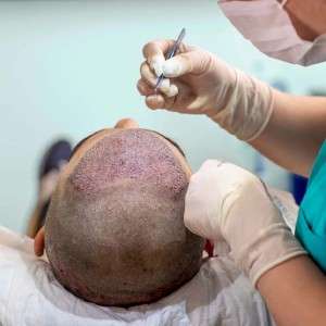 Hair Transplant in Delhi