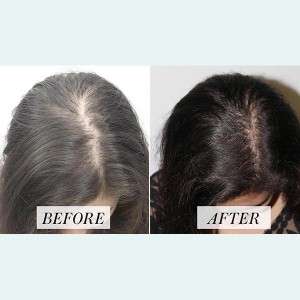 PRP  Hair Treatment in Delhi